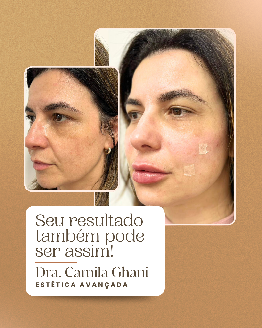 Resultado antes e depois 1 — Protocolo Ghani Lift