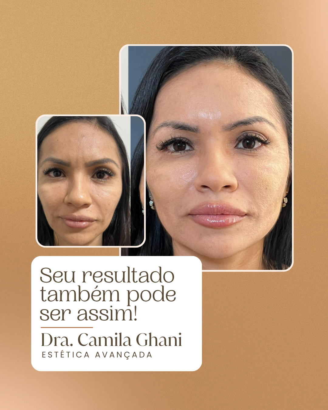 Resultado antes e depois 2 — Protocolo Ghani Lift