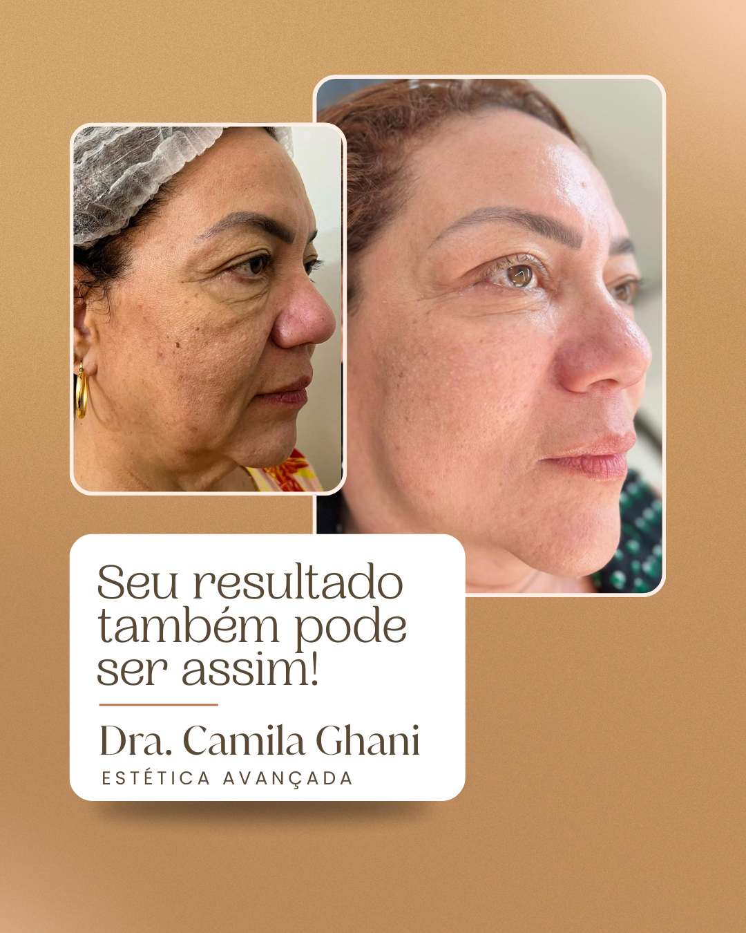Resultado antes e depois 3 — Protocolo Ghani Lift